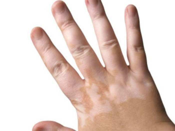 Doa menyembuhkan vitiligo