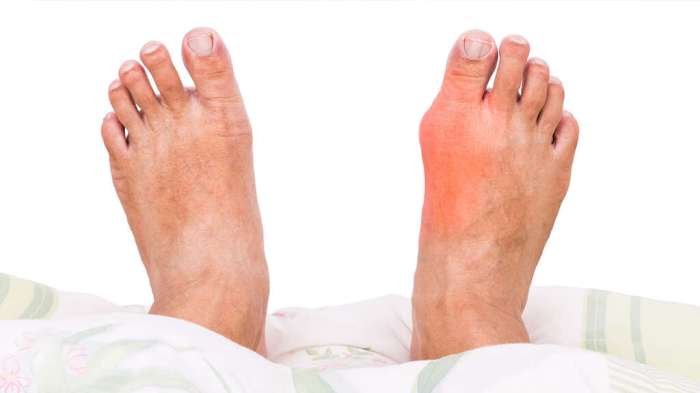 Gout healing remedy magers